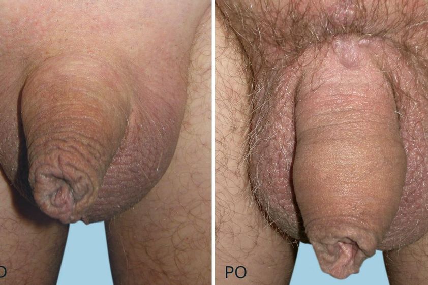 Zvětšení penisu před a po - 716471