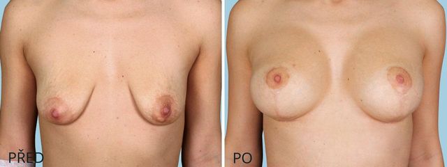 plastika povislych prsou modelace zvetseni 3 1
