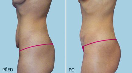 ABDIMINOPLASTIKA 2138 2