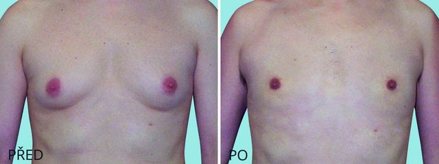 plastika zmenseni muzske prsni zlazy gynekomastie 2555 1