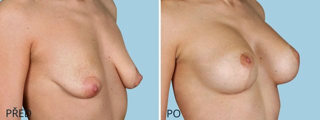 plastika povislych prsou modelace zvetseni 3 2