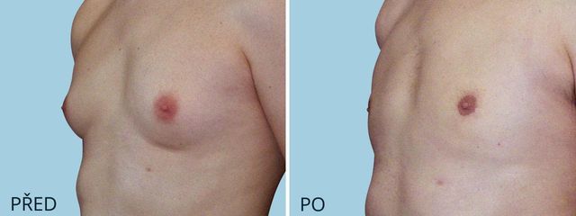 plastika zmenseni muzske prsni zlazy gynekomastie 2555 2