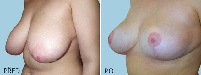 zmenseni prsou redukce 860 2