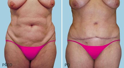 ABDIMINOPLASTIKA 2652 1