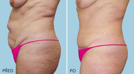 ABDIMINOPLASTIKA 2652 2