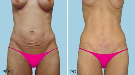 ABDIMINOPLASTIKA 2957 1