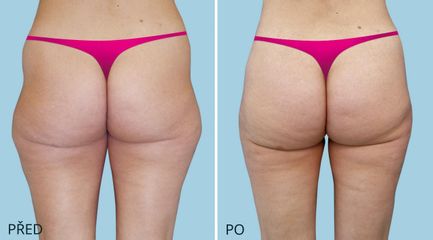 LIPOSUKCE 2870 2 2