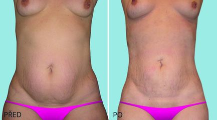 LIPOSUKCE BRICHO 1 1