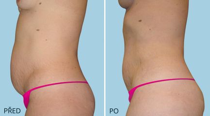 LIPOSUKCE BRICHO 1 2