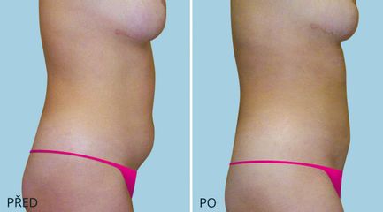 LIPOSUKCE BRICHO 2 2