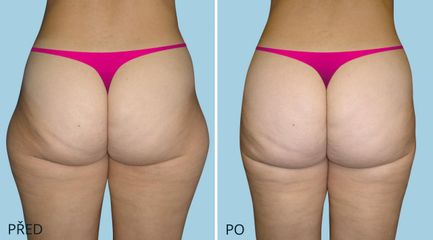 LIPOSUKCE KYCEL krajiny
