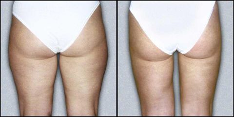 lipo4 pred