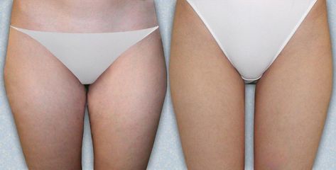 liposukce 02 1