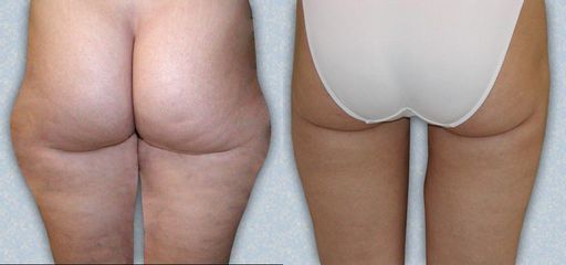 liposukce 02 3