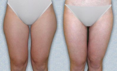 liposukce 03 1