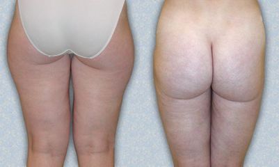 liposukce 03 3