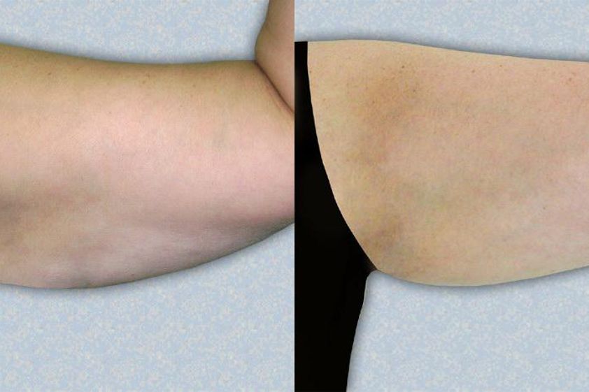 Karboxyterapie před a po - 719174