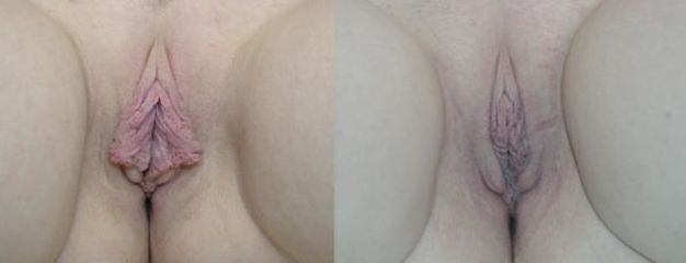 labio1
