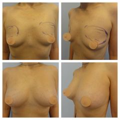 lipofilling -MUDr. Ivo Menšík, Ph.D. - BODY klinika plastické chirurgie