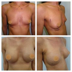 augmentace MUDr. Ivo Menšík, Ph.D. - BODY klinika plastické chirurgie