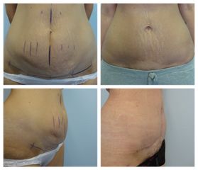 MUDr. Ivo Menšík, Ph.D. - BODY klinika plastické chirurgie
