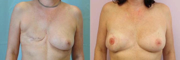 Rekonstrukce prsu lalokem, lipografting přístrojem Body-jet, tetováž dvorce