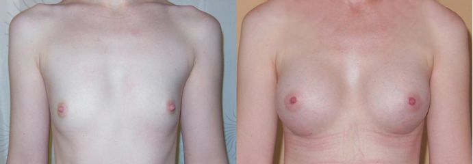 Foceno po 1 měsíci od zákroku, Mentor anatomický 250 ml