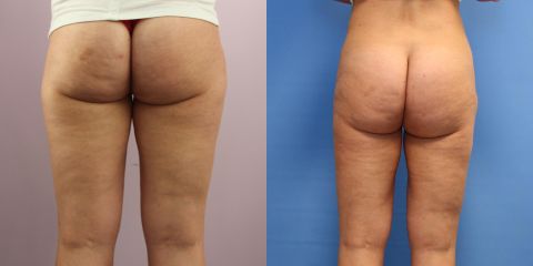 Liposukce pomocí přístroje Body-jet – oblast vnější stehna