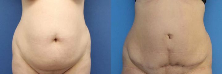 Abdominoplastika (operace břicha)