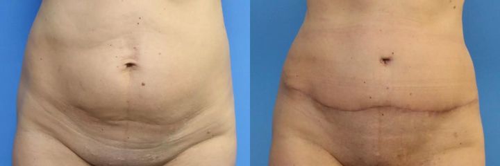 Abdominoplastika (operace břicha)