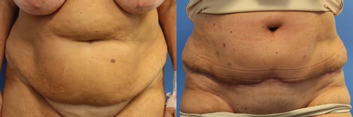 Abdominoplastika (operace břicha)