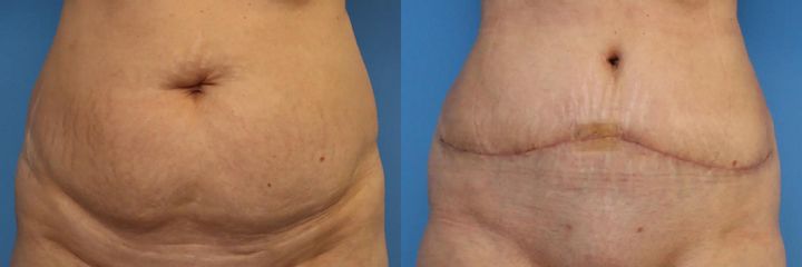 Abdominoplastika (operace břicha)