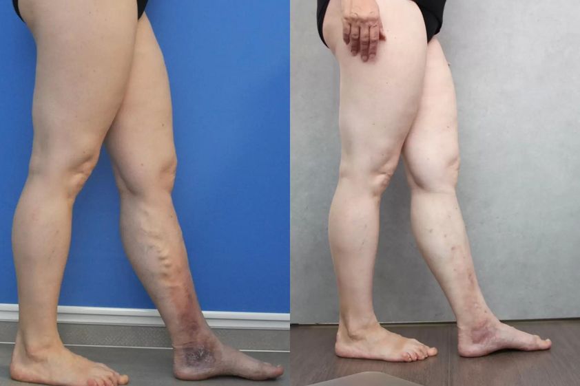 Laserová operace křečových žil před a po - 735102