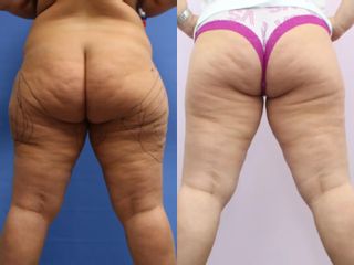 Liposukce pomocí přístroje Body-jet – oblast vnější stehna