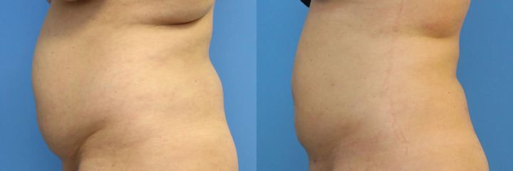 Liposukce pomocí přístroje Body-jet – boky a břicho