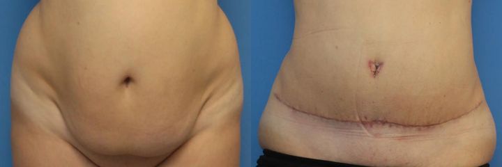 Abdominoplastika (operace břicha)