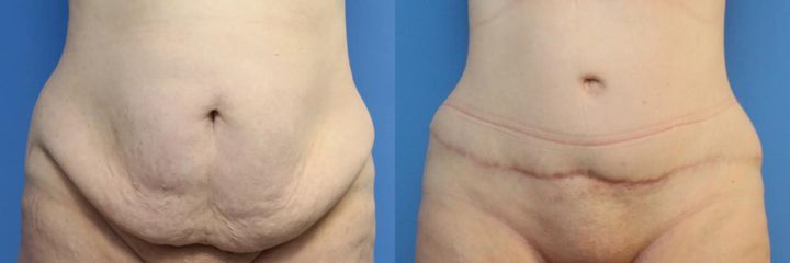 Abdominoplastika (operace břicha)