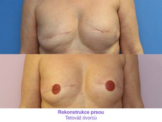 Rekonstrukce prsu před a po - 736733