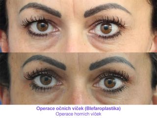 Operace očních víček (Blefaroplastika)