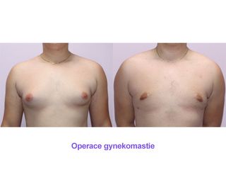 Operace gynekomastie