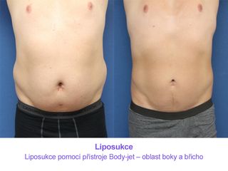 Liposukce