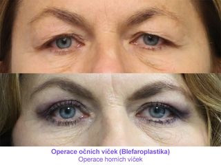 Operace očních víček (Blefaroplastika)