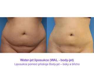 Water-jet liposukce (WAL - body-jet)