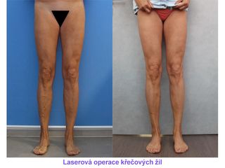 Laserová operace křečových žil