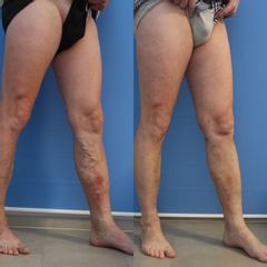 Laserová operace křečových žil - GIA Clinic s.r.o.