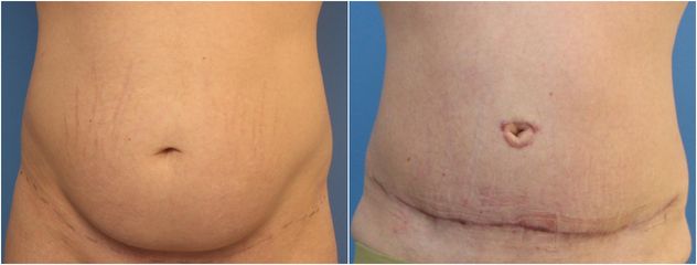 Abdominoplastika - GIA Clinic s.r.o.