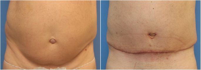 Abdominoplastika - GIA Clinic s.r.o.