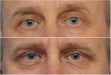Operace očních víček - GIA Clinic s.r.o.