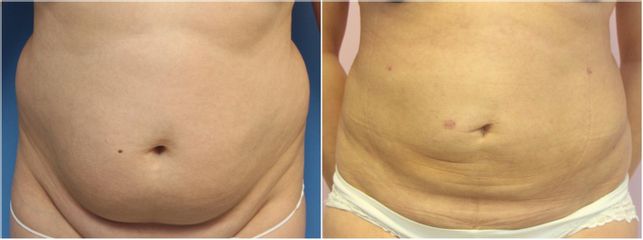Liposukce - GIA Clinic s.r.o.