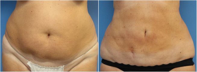 Liposukce - GIA Clinic s.r.o.